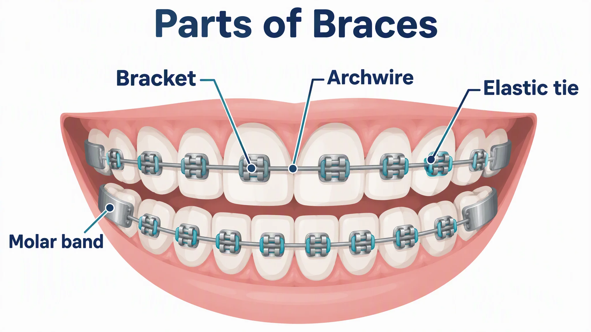 AI-generated front view of teeth with braces labeled bracket, archwire, elastic tie and molar band