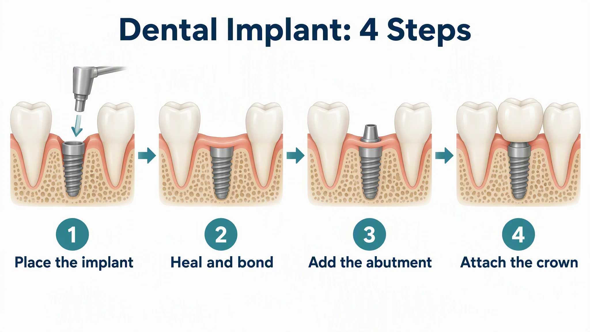 AI-generated four step dental implant diagram: place the implant, heal and bond, add the abutment, attach the crown