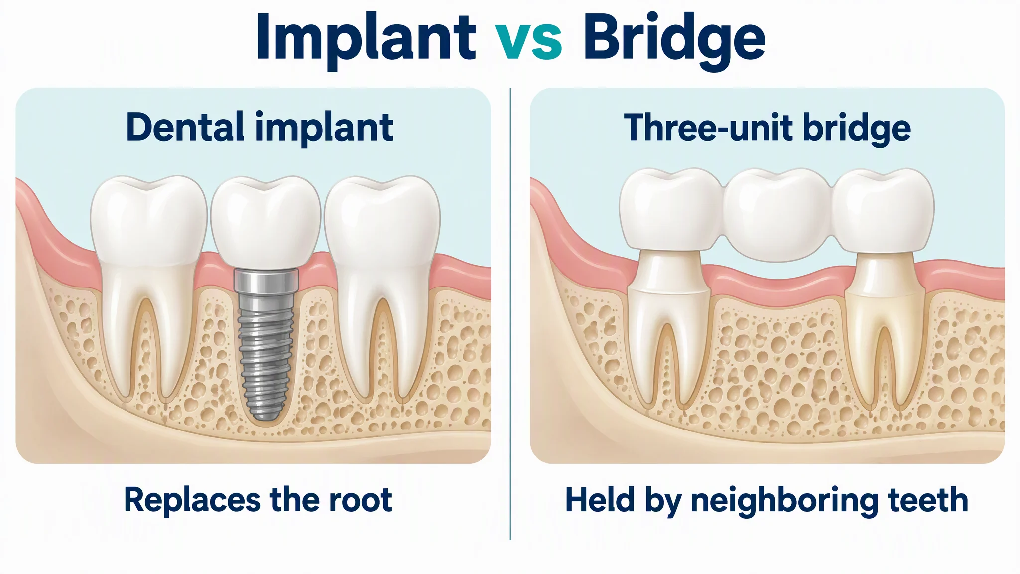 AI-generated comparison of a single dental implant and a three-unit dental bridge held by two neighboring teeth