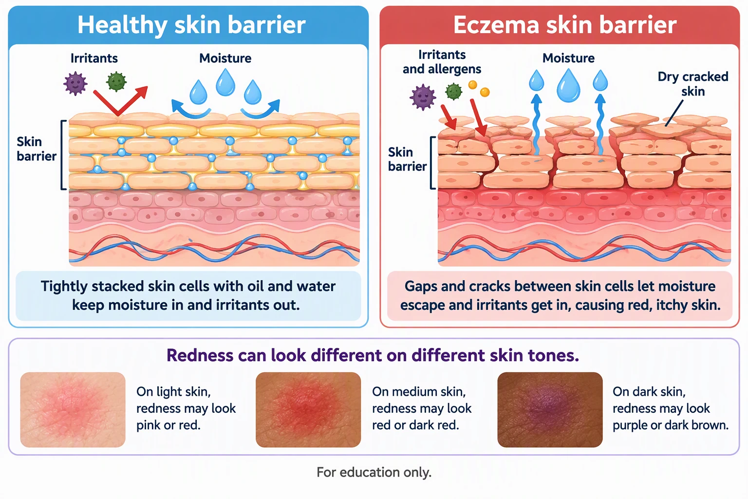 AI-generated patient education comparison of a healthy skin barrier and an eczema skin barrier, with redness shown on light, medium, and dark skin tones