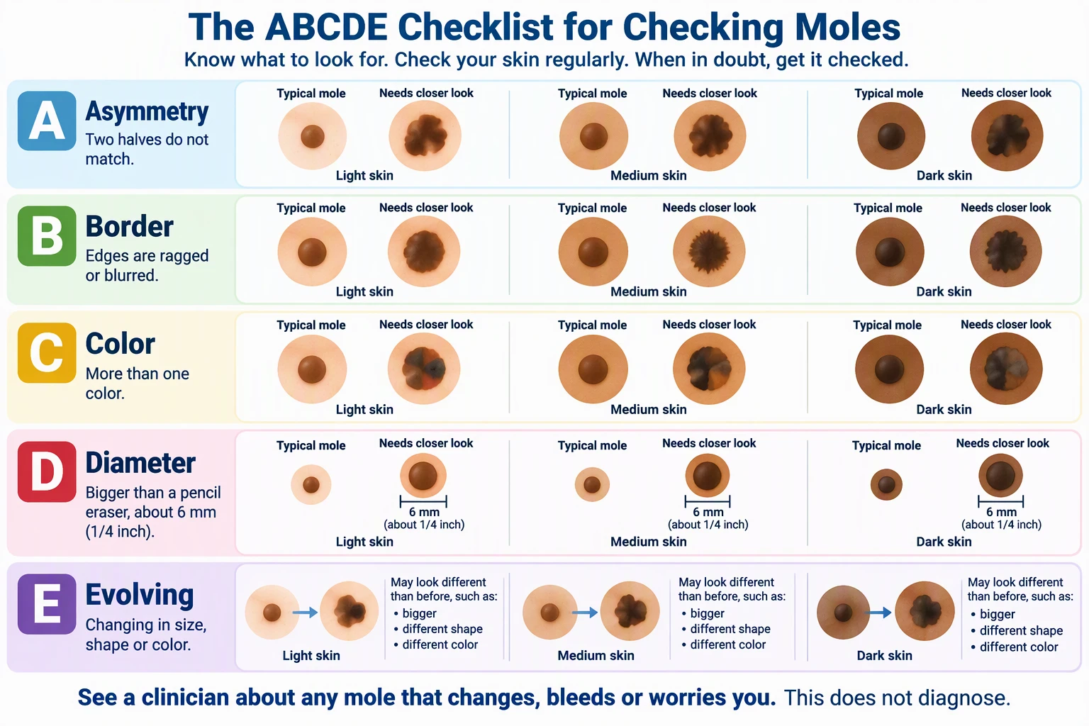 AI-generated patient education chart of the ABCDE checklist for moles, with typical and concerning examples on light, medium, and dark skin tones