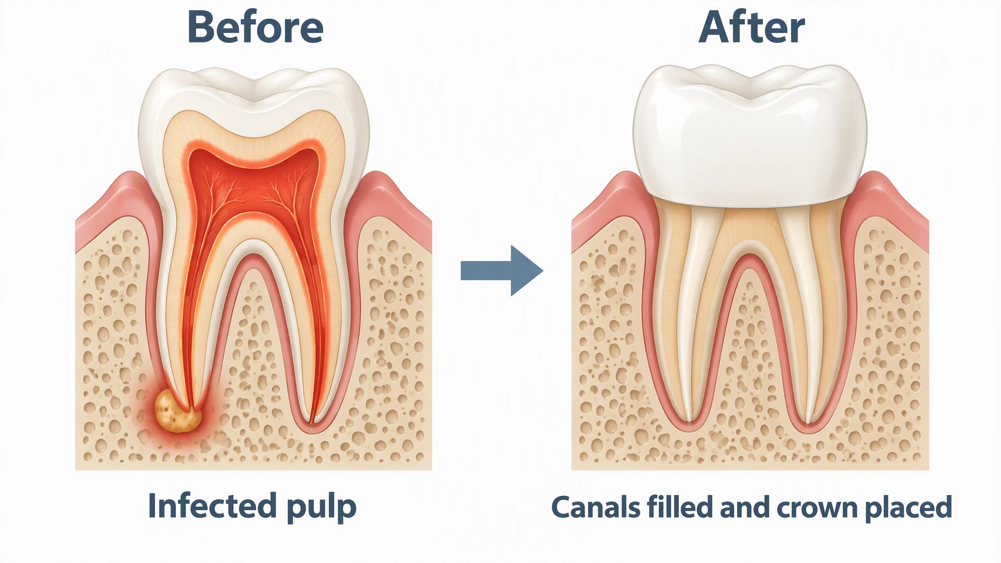 AI-generated before and after comparison of a tooth: inflamed pulp with root tip infection, then canals filled and a crown placed