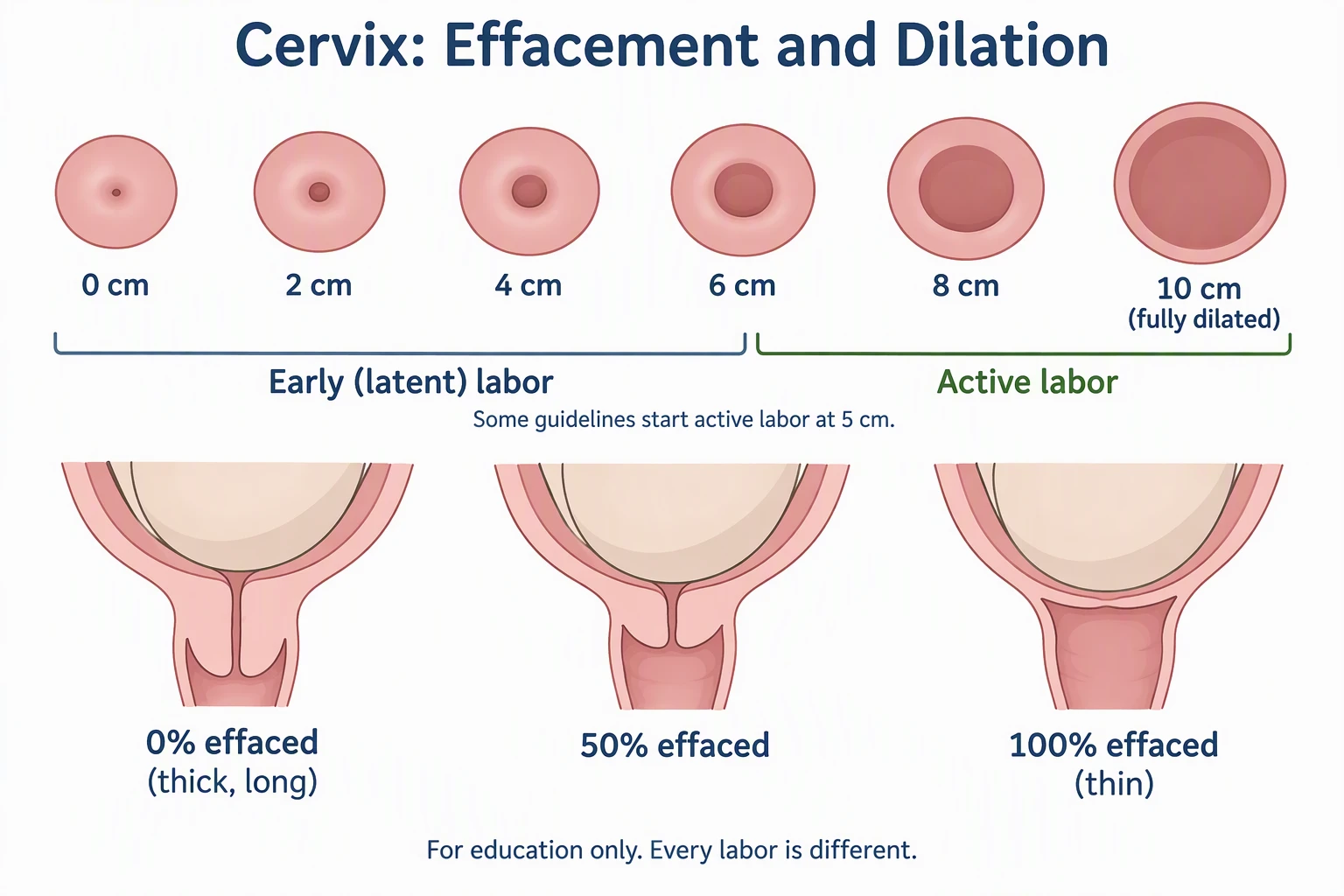 AI-generated patient education illustration of cervical dilation from 0 to 10 cm and effacement from 0 to 100 percent